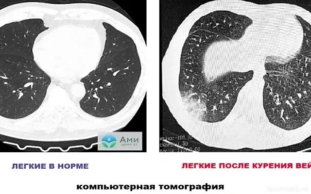 В Томске у подростка выявили новую болезнь вейперов EVALI — Новости