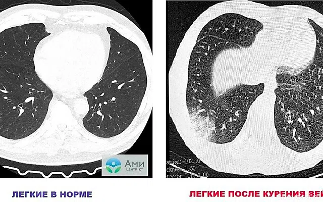 В Томске у подростка выявили новую болезнь вейперов EVALI — Новости