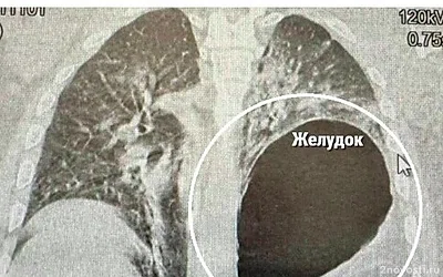 Минздрав России сообщил о россиянине с оказавшимся на месте легкого желудком — Новости