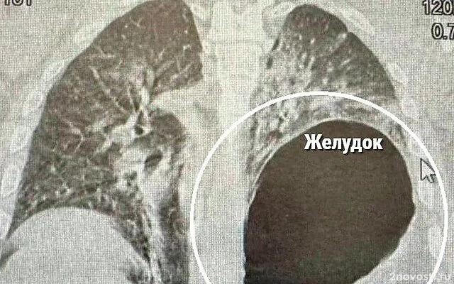 Минздрав России сообщил о россиянине с оказавшимся на месте легкого желудком — Новости