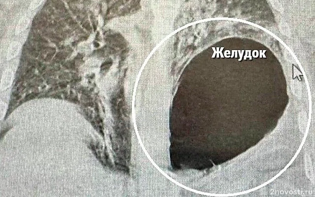Минздрав России сообщил о россиянине с оказавшимся на месте легкого желудком — Новости