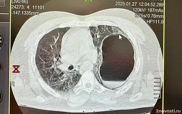 Минздрав России сообщил о россиянине с оказавшимся на месте легкого желудком — Новости