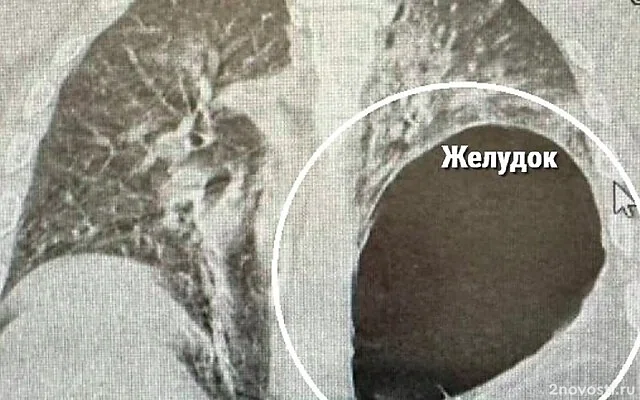 Минздрав России сообщил о россиянине с оказавшимся на месте легкого желудком — Новости