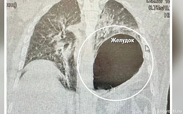 Минздрав России сообщил о россиянине с оказавшимся на месте легкого желудком — Новости