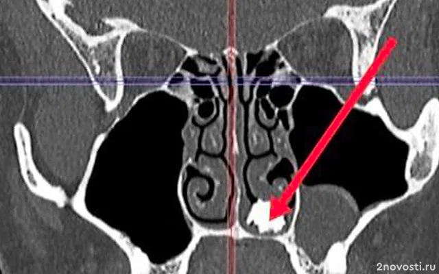 В Подмосковье врачи нашли в носу у 22-летнего юноши с насморком молочный зуб — Новости