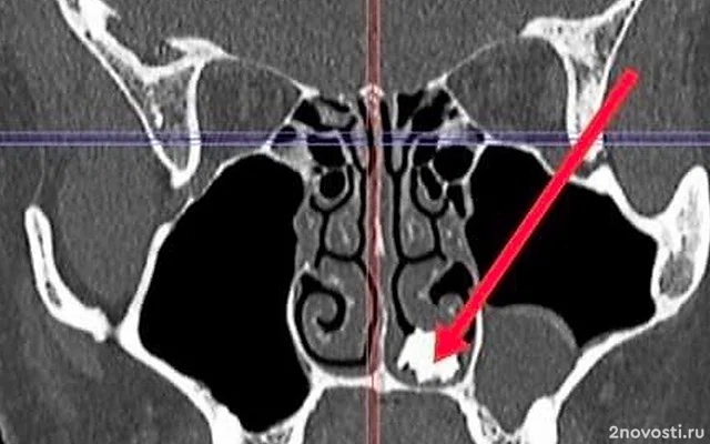 В Подмосковье врачи нашли в носу у 22-летнего юноши с насморком молочный зуб — Новости