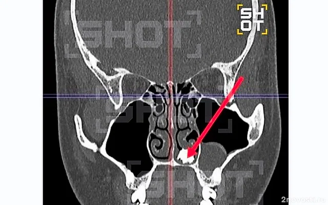 В Подмосковье врачи нашли в носу у 22-летнего юноши с насморком молочный зуб — Новости