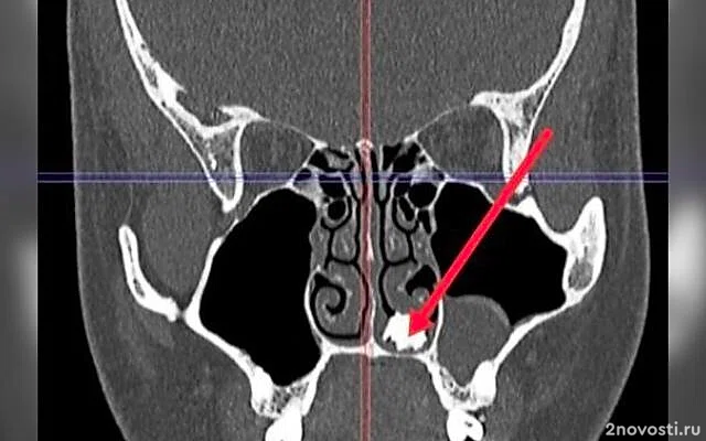 В Подмосковье врачи нашли в носу у 22-летнего юноши с насморком молочный зуб — Новости