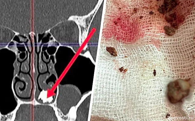 В Подмосковье врачи нашли в носу у 22-летнего юноши с насморком молочный зуб — Новости